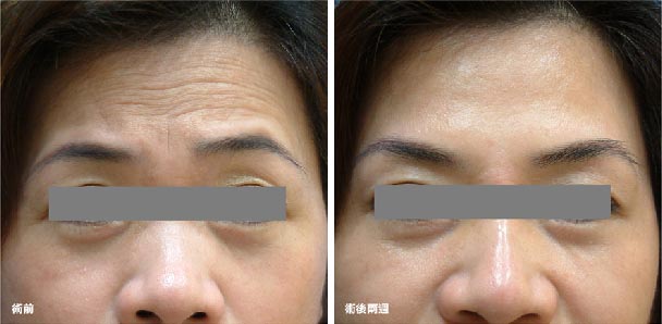 玻尿酸去除抬头纹的效果好吗