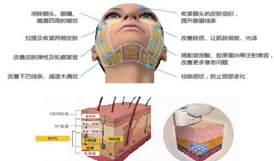 超声理疗仪除皱