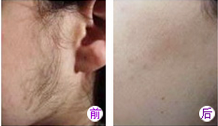 脱毛前后对比图