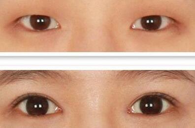 双眼皮的方法