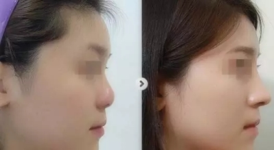 玻尿酸隆鼻前后对比图