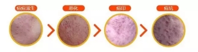 痘 印