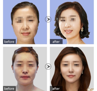 提拉前后对比图