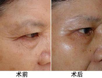 在北京祛鱼尾纹怎样去除