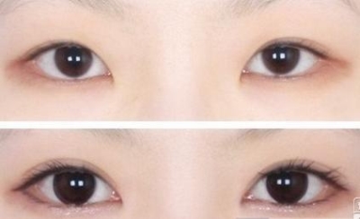 双眼皮修复术，还原你的美