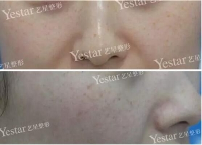 北京做皮秒激光哪里好?闺蜜素到“无妆”靓爆镜