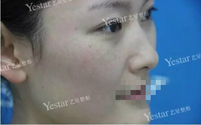 北京做皮秒激光哪里好?闺蜜素到“无妆”靓爆镜