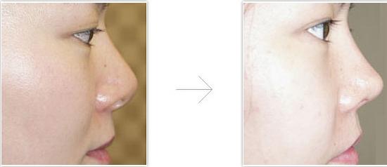 北京做假体隆鼻的价格多少