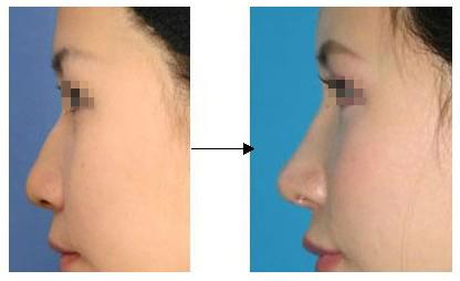 北京做假体隆鼻的价格多少