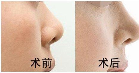 北京做假体隆鼻的价格多少
